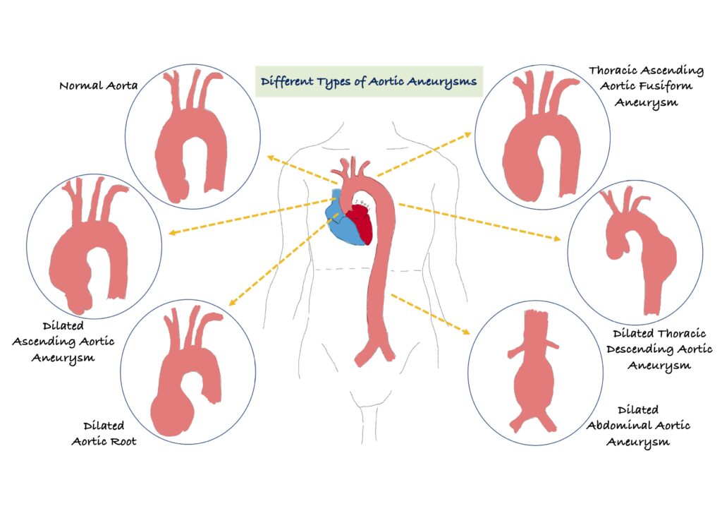 Aortic disease